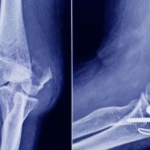 ANMAT advierte que un tornillo utilizado en cirugías traumatológicas es falso