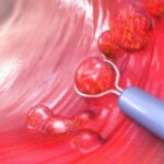 Cáncer de colon, ¿los 45 son los nuevos 50?: por qué aconsejan adelantar los controles