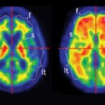 Vínculos sorprendentes entre el autismo y el Alzheimer podrían cambiar la forma en que tratamos ambos